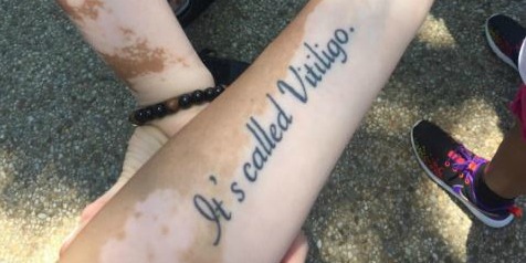 arm with "it's called vitiligo" tattoo