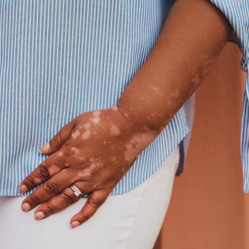 Need To Know About Vitiligo As An Autoimmune Disease | Living Dappled