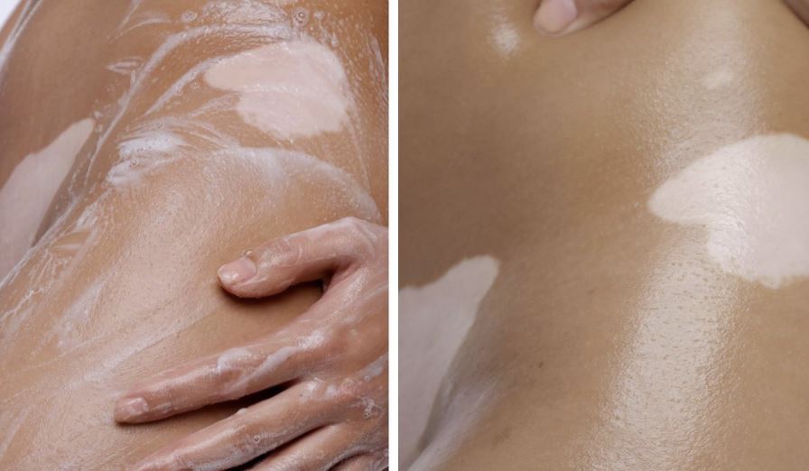 woman's skin with vitiligo spots and soap