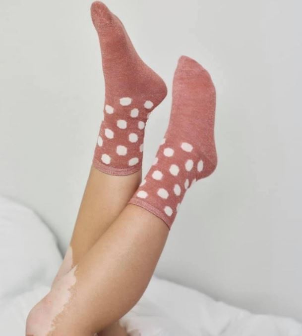 legs with vitiligo wearing pink polka dot socks
