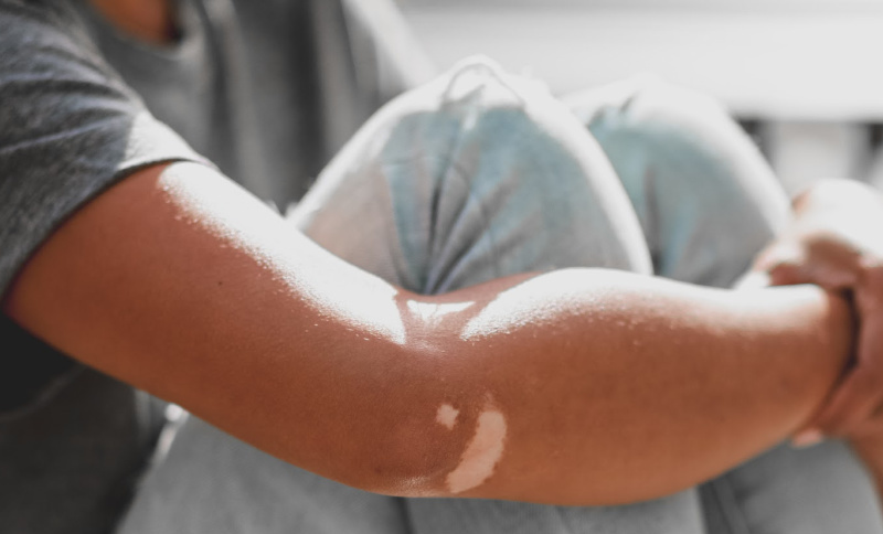The psychological influence of vitiligo |  Dwelling Noticed