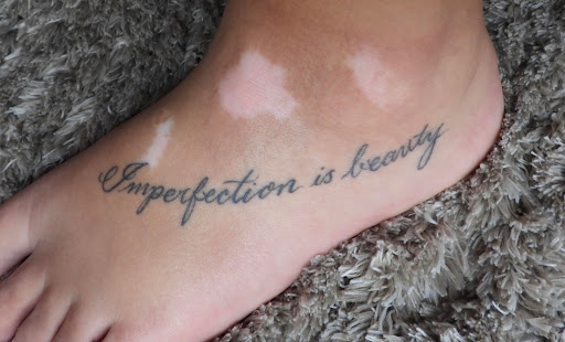 tattoo on foot with vitiligo