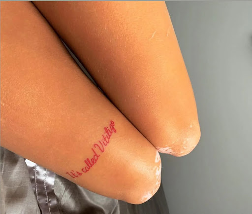 It’s called vitiligo tattoo
