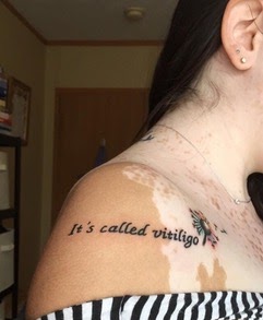 woman with vitiligo and a tattoo on her shoulder