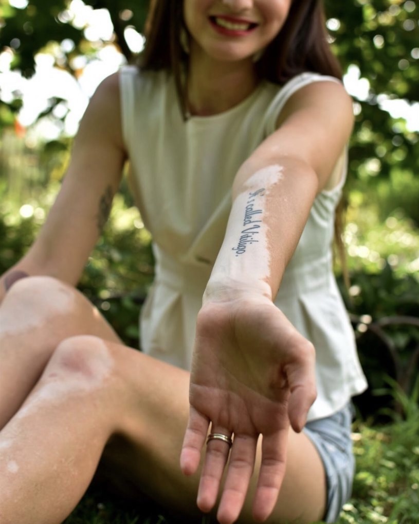 woman with “it’s called vitiligo” tattoo