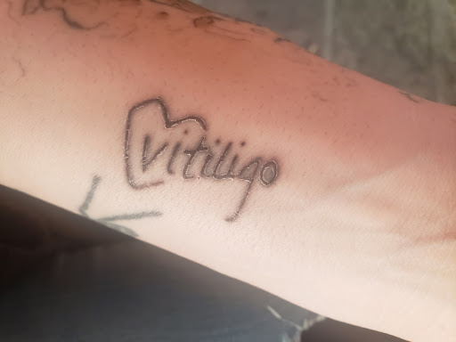 vitiligo tattoo
