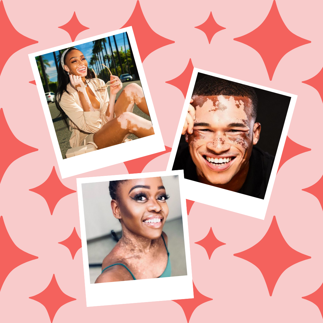 5 Types Of Vitiligo And What They Mean Living Dappled