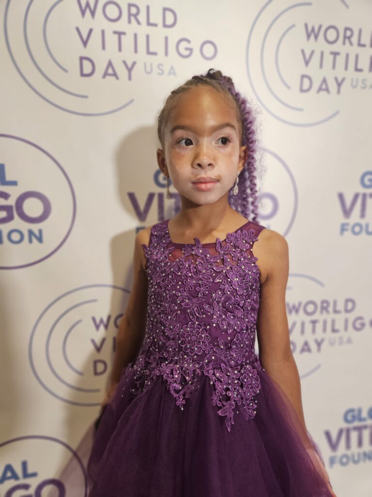 Girl with vitiligo at World Vitiligo Day USA