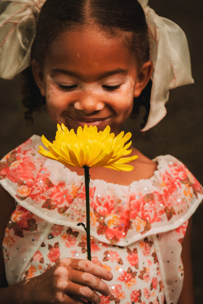 Girl with vitiligo smiles and holds a yellow flower