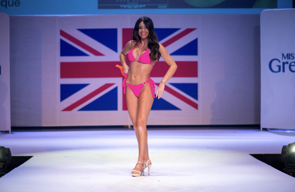 Aimee McKay, with visible vitiligo, poses in a bikini for Miss Great Britain Glasgow